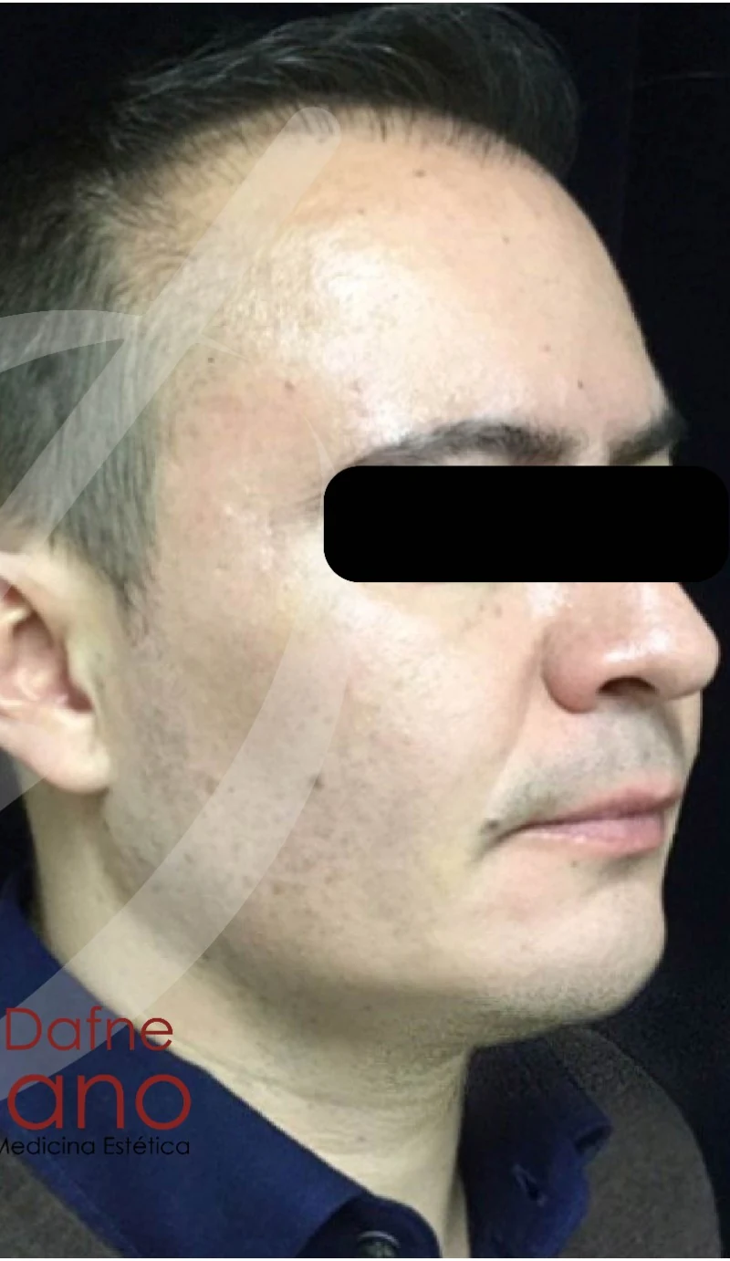 Caso 1 armonización facial antes/después — Después