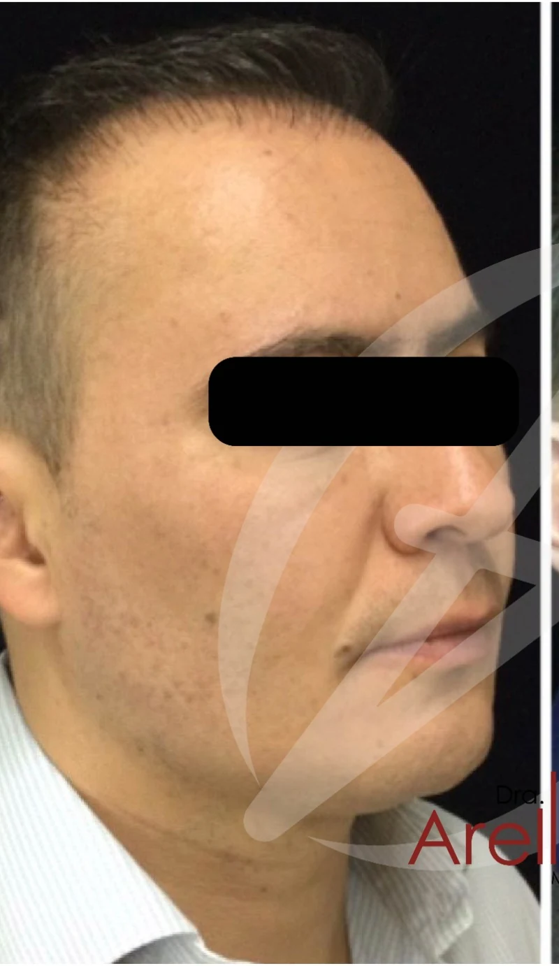Caso 1 armonización facial antes/después — Antes