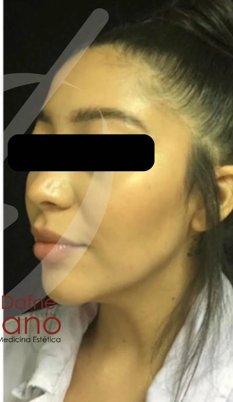 Caso 2 armonización facial antes/después — Después