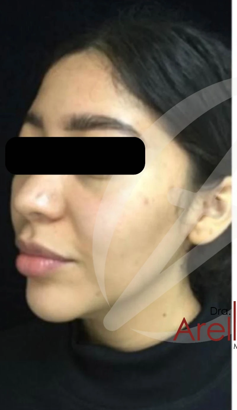Caso 2 armonización facial antes/después — Antes