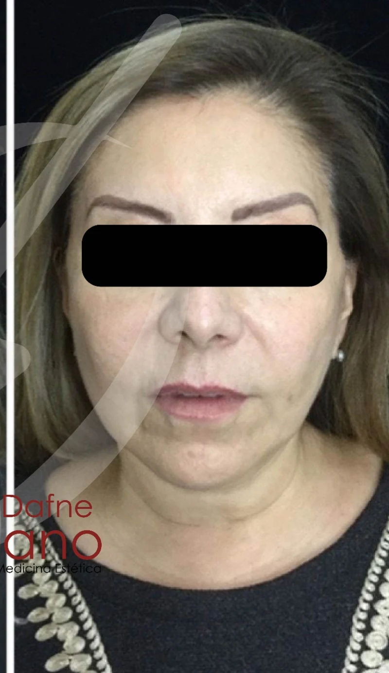 Caso 3 armonización facial antes/después — Después