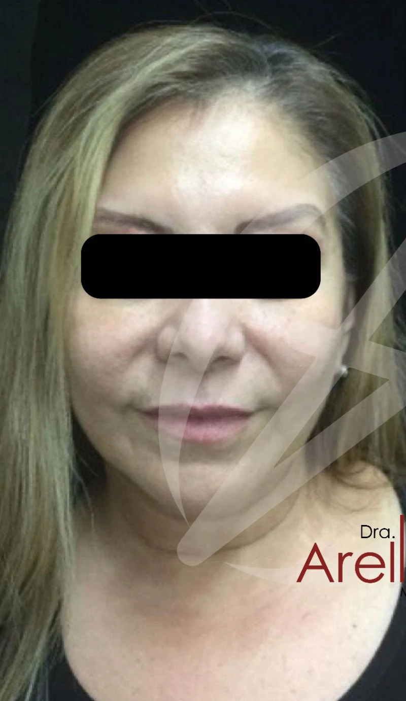 Caso 3 armonización facial antes/después — Antes