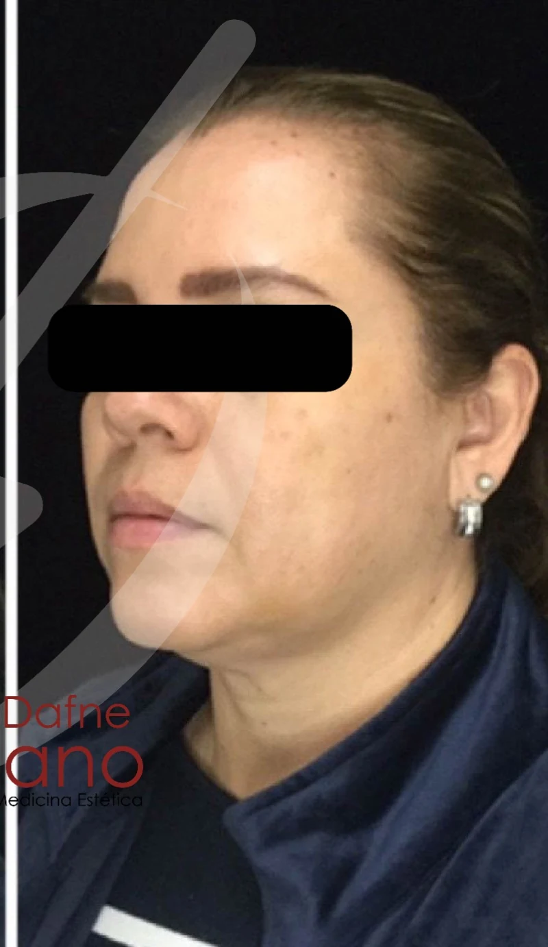 Caso 4 armonización facial antes/después — Después