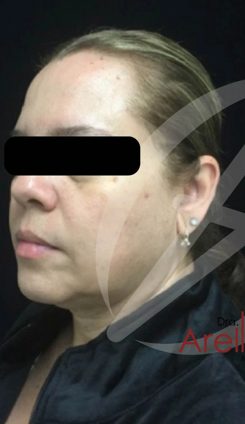 Caso 4 armonización facial antes/después — Antes
