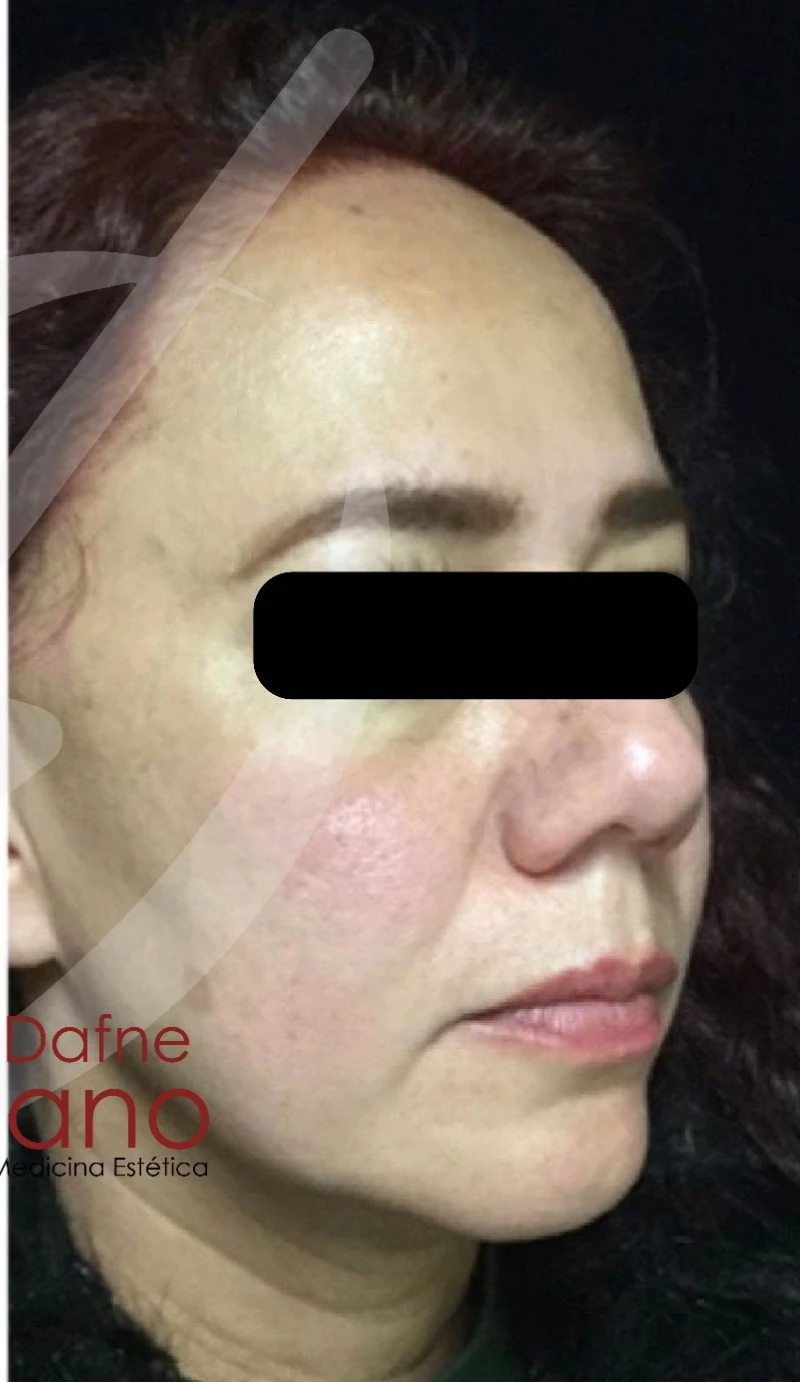 Caso 5 armonización facial antes/después — Después