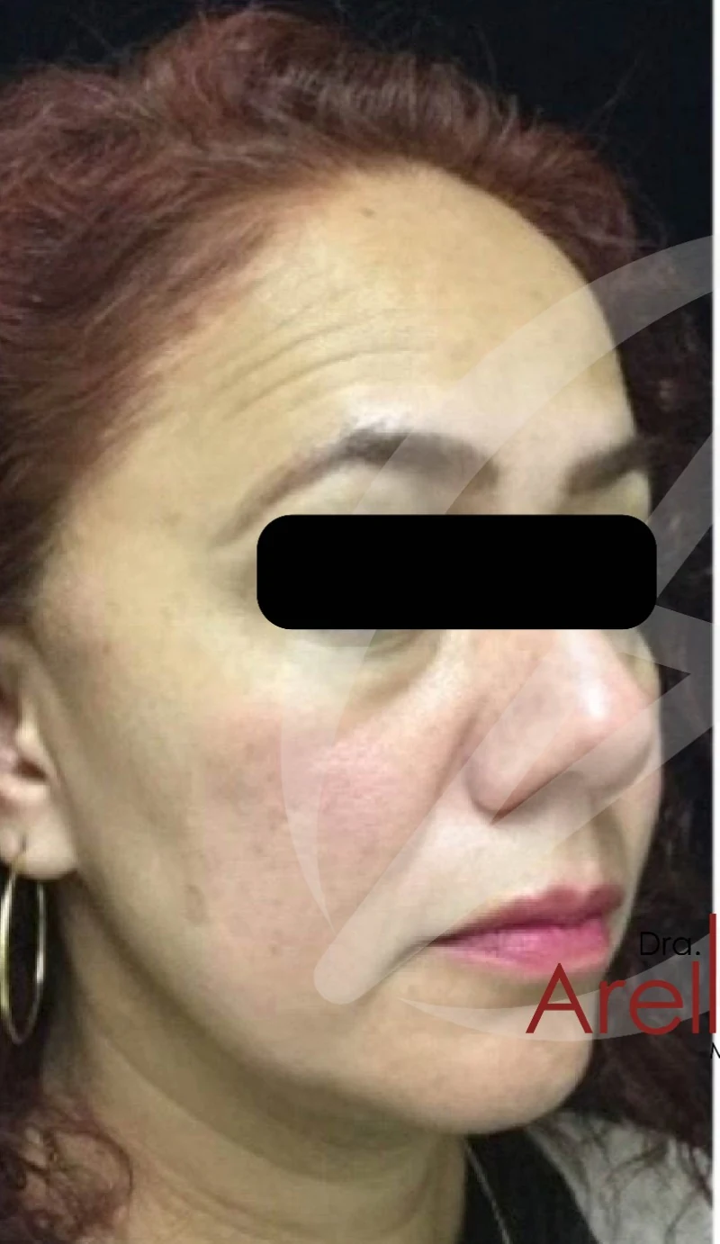 Caso 5 armonización facial antes/después — Antes
