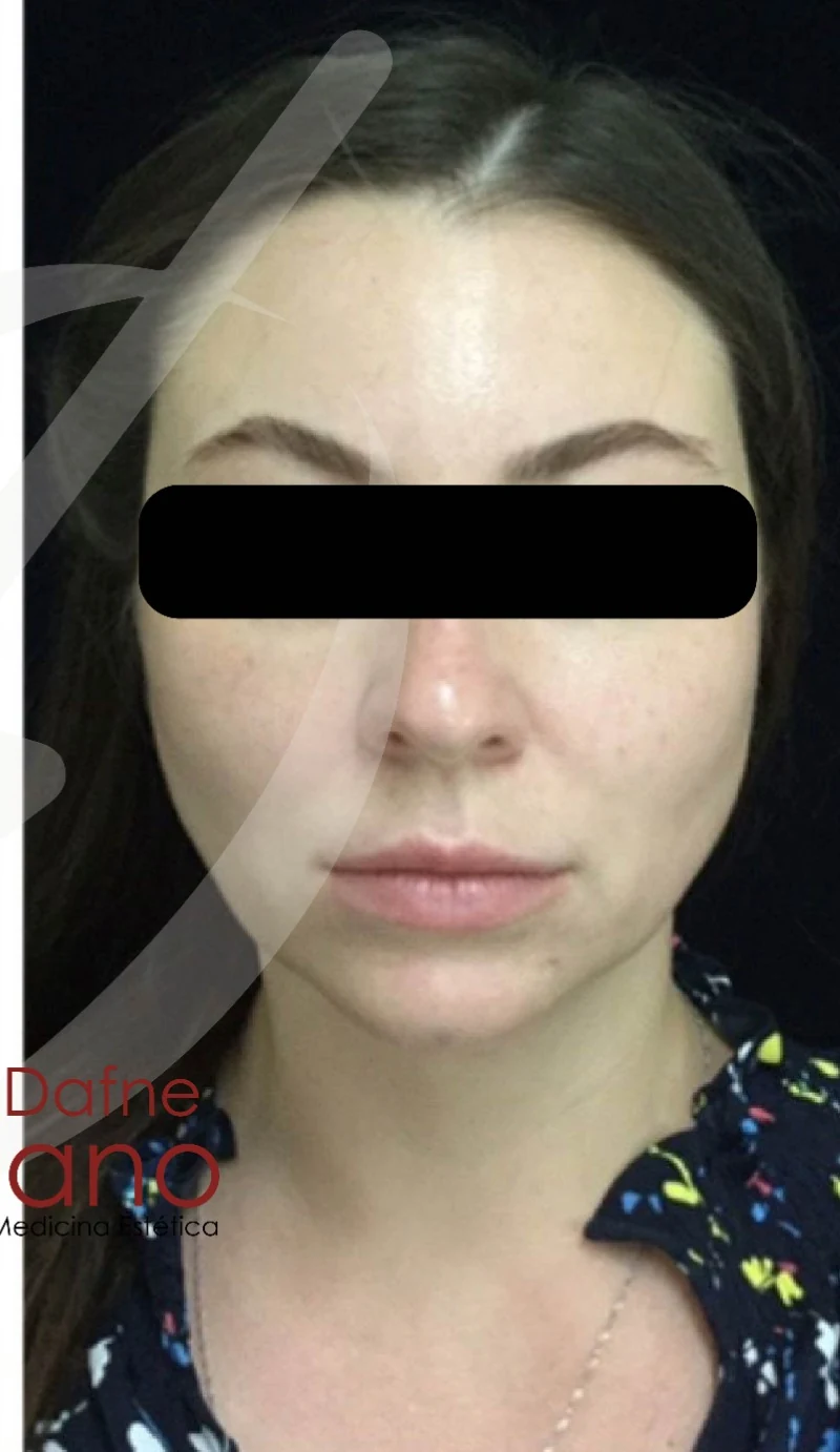 Caso 6 armonización facial antes/después — Después