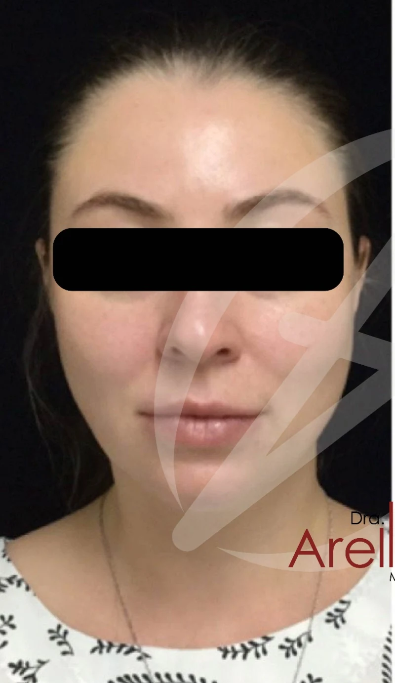 Caso 6 armonización facial antes/después — Antes