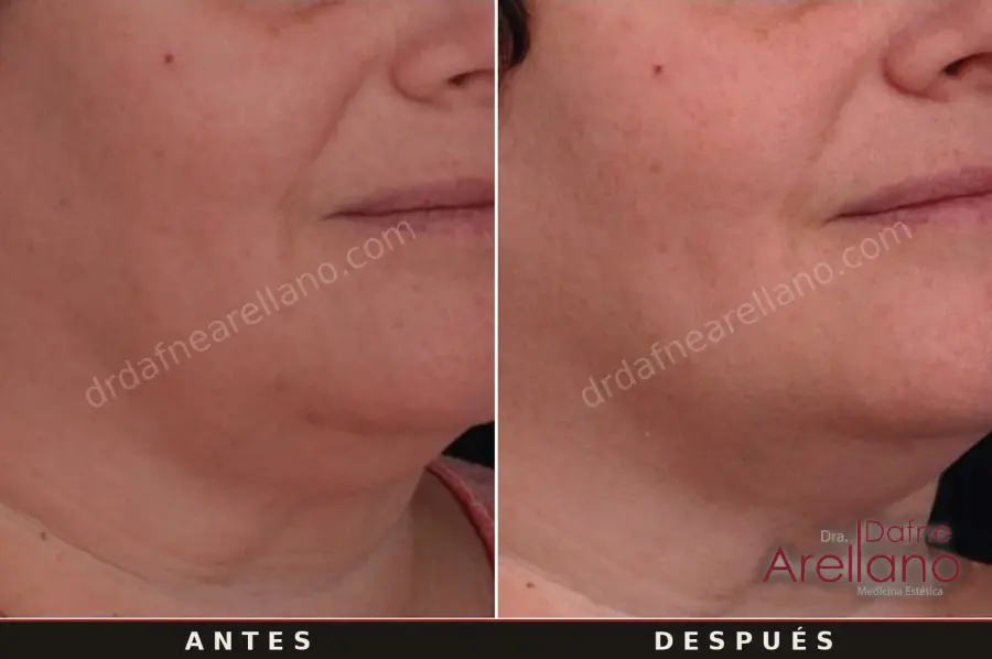 Antes y después · EndyMed · contorno facial